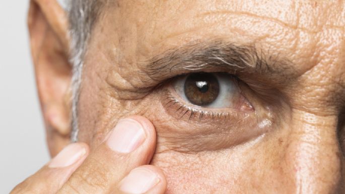 ¿Qué es el glaucoma y por qué se da? Estas son sus causas y consecuencias