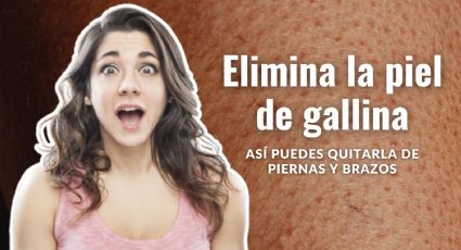 ¿Qué hacer para eliminar la piel de gallina? Así puedes quitarla de piernas y brazos