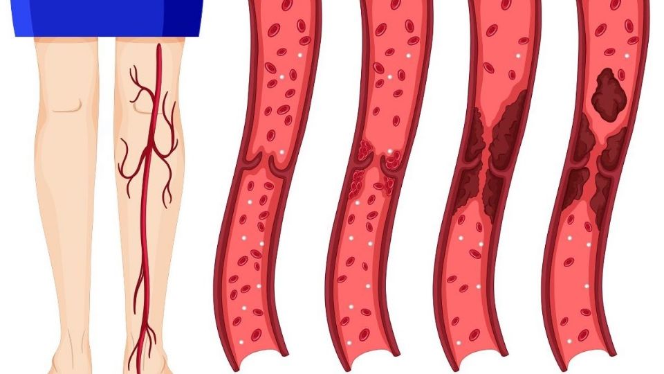 ¿Qué es y qué causa una trombosis?