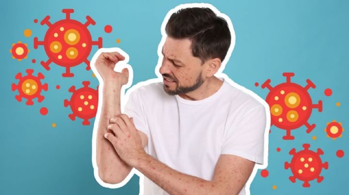 Viruela del mono: Qué es, cómo se contagia y síntomas principales