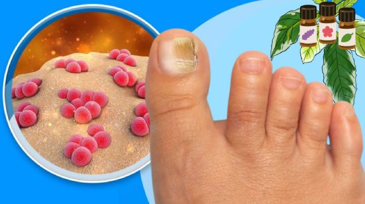 ¿Tienes hongos en las uñas de los pies? Estos son los remedios caseros más eficaces